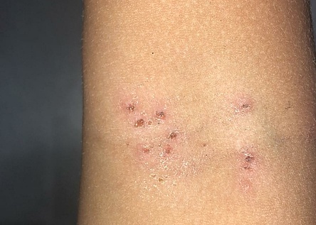 Haut_impetigo_borkenflechte_eigen
