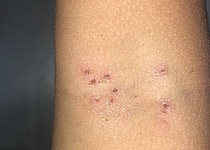 Haut_impetigo_borkenflechte_eigen